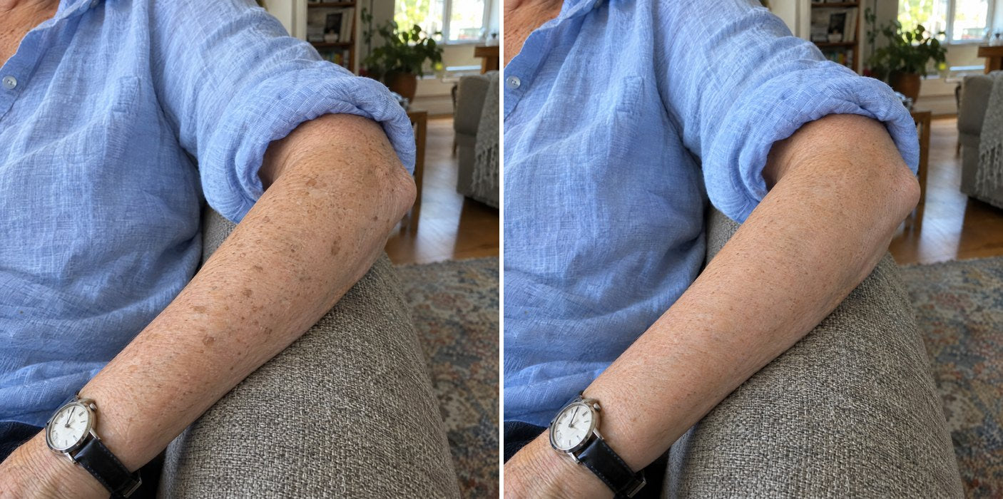 Customer photos, forearm