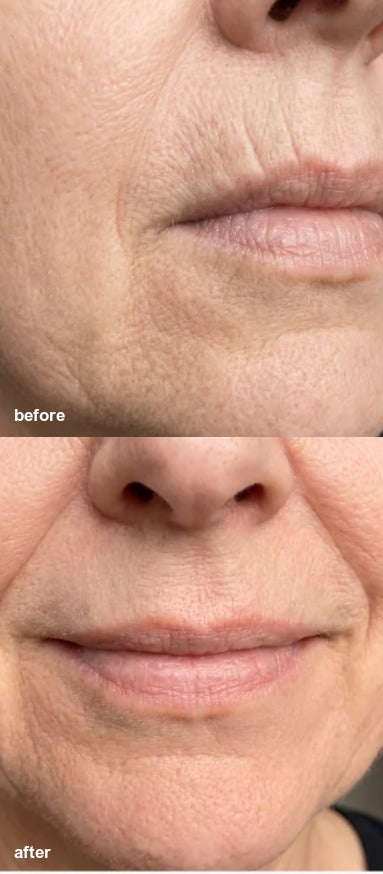 Before and after K-Smooth