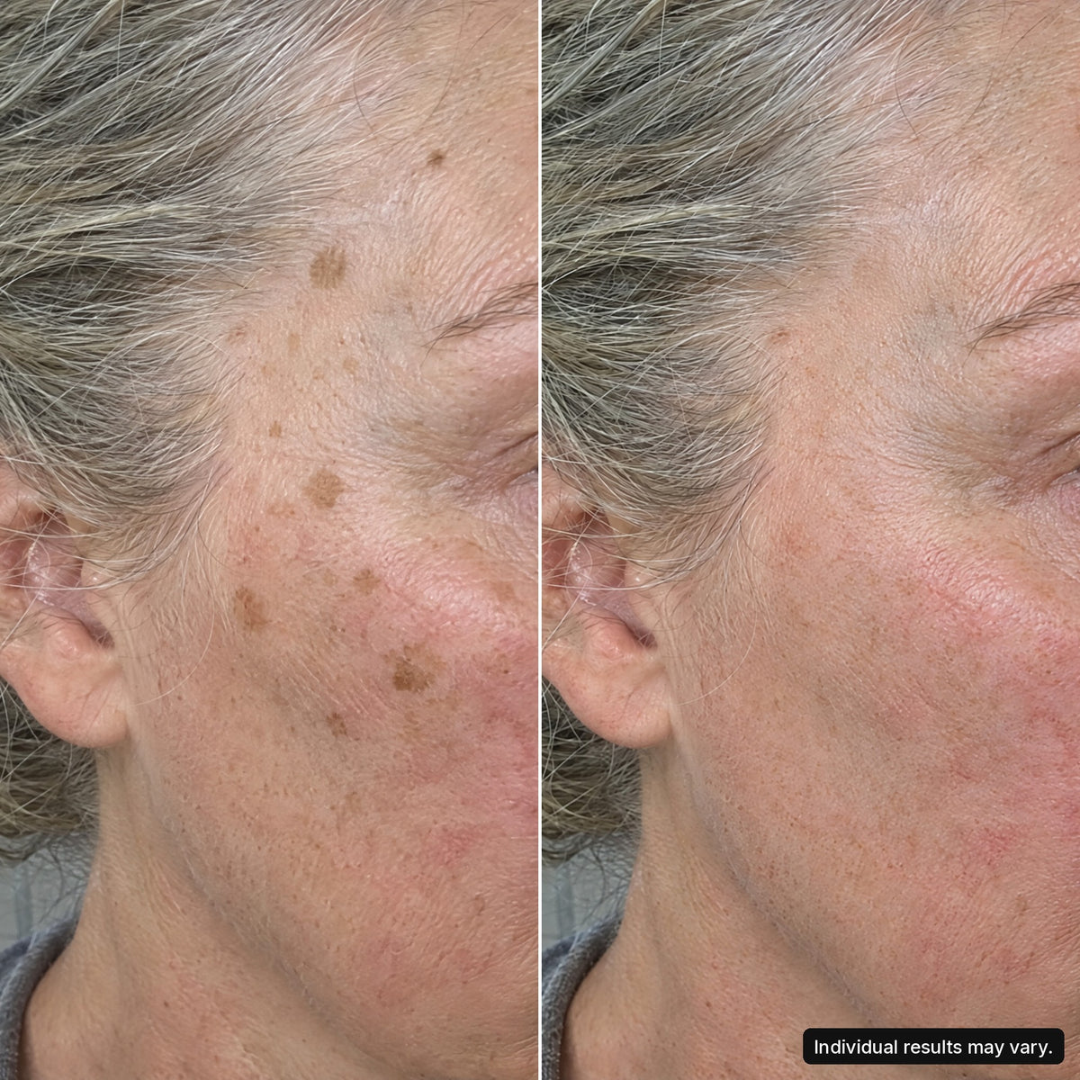 Customer photo, cheek, 14 days