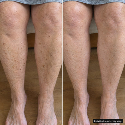 Customer photo, legs, 8 weeks