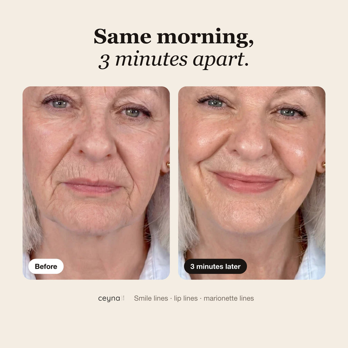 Before and 3 minutes after, lines around the mouth