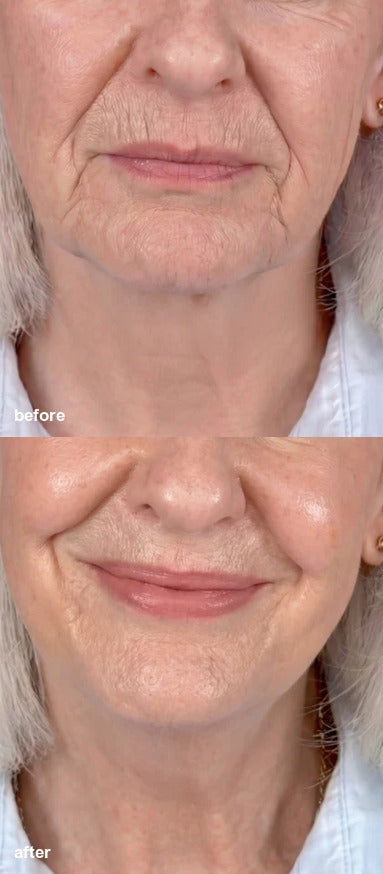 Before and after K-Smooth